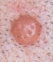 Skin Cancer - Melanoma