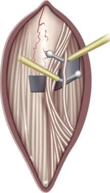 The L-2 dorsal root is easily identified. In an at