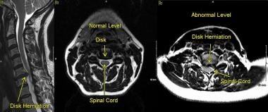 (Left) MRI, Sagittal T2 sequence, demonstrating a 