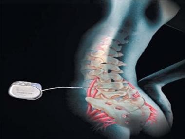 Sacral Nerve Stimulation (SNS) - Bowel / Faecal Incontinence