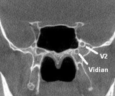 Coronal computed tomographic image of the sphenoid