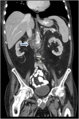 CT of the abdomen and pelvis using PO and IV contr