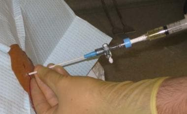 Paracentesis. Filling of syringe with ascitic flui
