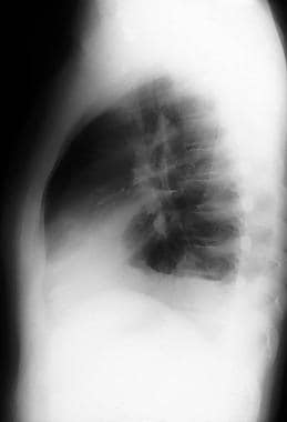 Lateral view in a child with right-sided pleural e