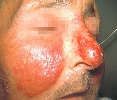 gross skin infections