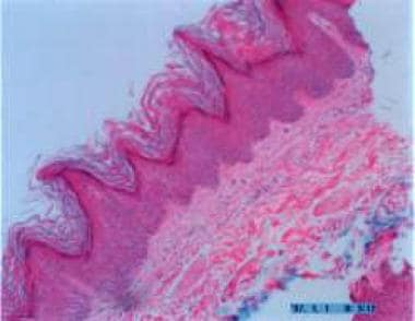 seborrheic keratosis histology