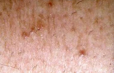 perforating folliculitis