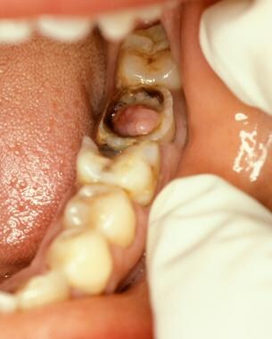 Hyperplastic Pulpitis  