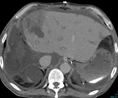 C-3: Infarction of the lateral part of a graft (mu