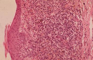 Hemosiderin deposition is seen in dermal macrophag