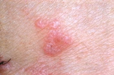 vesicular lichen planus