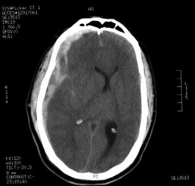 Acute right-sided subdural hematoma associated wit