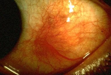 Scleritis. Courtesy of Wikipedia Commons. 