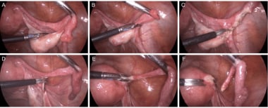 Laparoscopic salpingectomy. Fallopian tubes are re