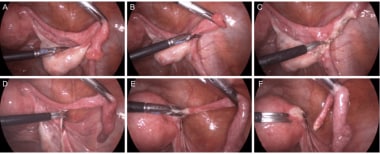 Ooforoplastia e salpingectomia laparoscópica / Oophoroplasty and  laparoscopic salpingectomy (left). 