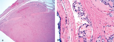 Follicular thyroid carcinoma: (left) Capsular inva