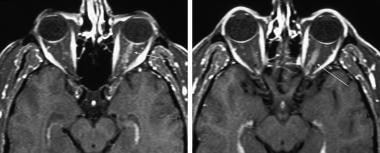 T1 contrast enhanced axial section of an MRI of th