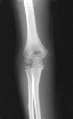 Normal contralateral elbow. 