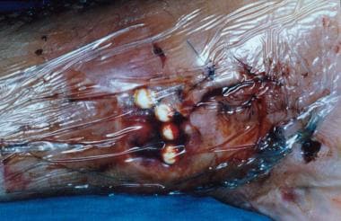 Necrotic area is excised, and bead pouch covers wo