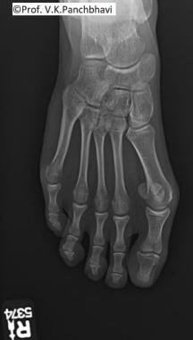 Preoperative anteroposterior view of hallux valgus