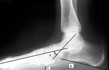 Pes planus (flatfoot). Standing lateral radiograph