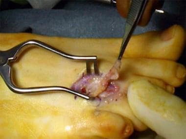 Surgery for Morton neuroma. Deeper dissection. 