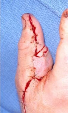 Postoperative view after a free tissue transfer of