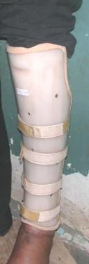 Patellar tendon-bearing brace fabricated from Orfi