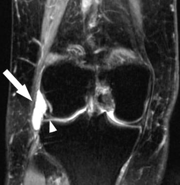 Meniscal cyst. Coronal T2-weighted magnetic resona