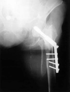 Failed fixation caused by fracture through screw h