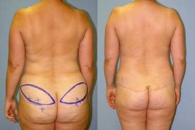 Before and after superior gluteal artery perforato