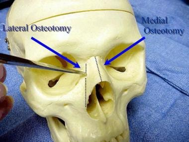 nasal bones