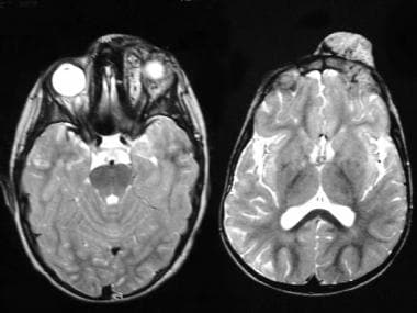 MRI of orbital hemangioma. 