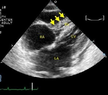 Early diastolic collapse of right ventricular free