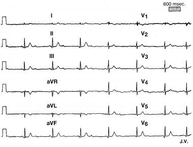 Representative 12-lead electrocardiogram in asympt