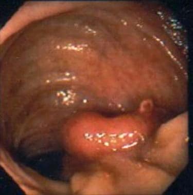 Villous Adenoma. Endoscopic view of a sessile poly