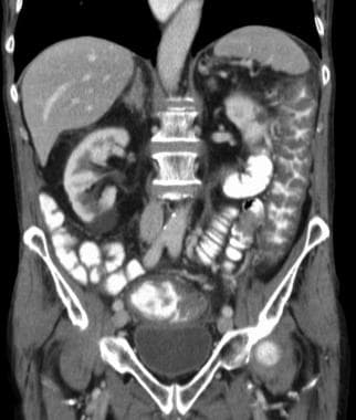 Clostridium difficile colitis súlycsökkenés