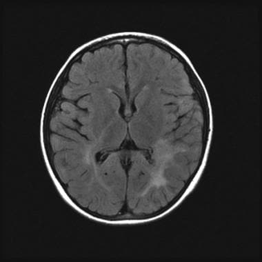 This axial FLAIR image shows bilateral, left predo
