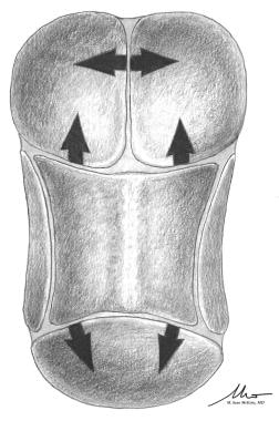 Sagittal craniosynostosis (scaphocephaly).