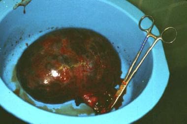 An ovarian cyst that underwent torsion (twisting o