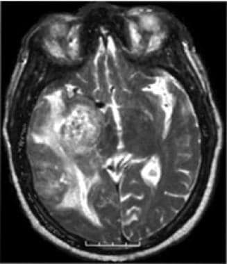 On T2-weighted axial MRI, the tumor (glioblastoma)