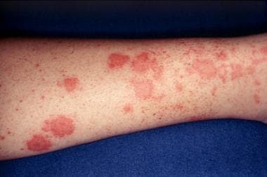 Rash on lower extremities typical of cutaneous sma