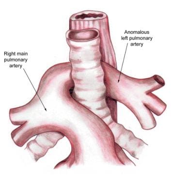 Aberrant left pulmonary artery or pulmonary artery