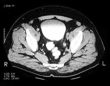 CT scan demonstrating left distal ureteral upper t