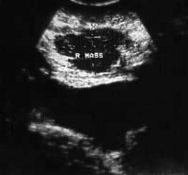 Rectus Sheath Hematoma. Ultrasound image of a rect