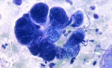Tzanck smear showing a multinucleated giant cell. 