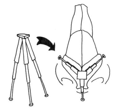 Demonstration of the nasal tripod concept. As with