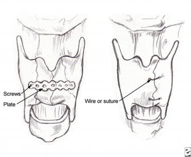 Various methods for laryngeal cartilage stabilizat
