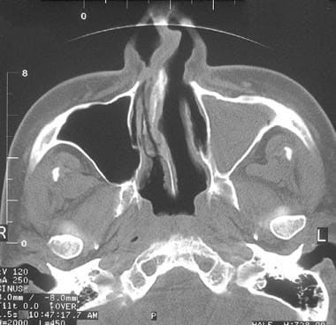 Axial CT scan demonstrating severe septal deviatio