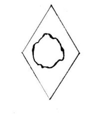 Rhombus drawn around the defect. 